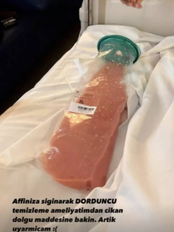 Danla Bilic kalçasından çıkan dolgu maddesini yayınladı: Gören küçük dilini yuttu 4